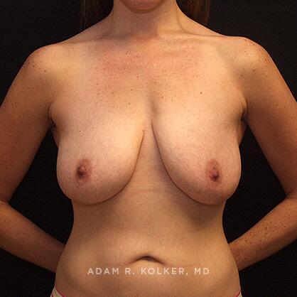 Breast Lift Before Image Patient 16 Front View