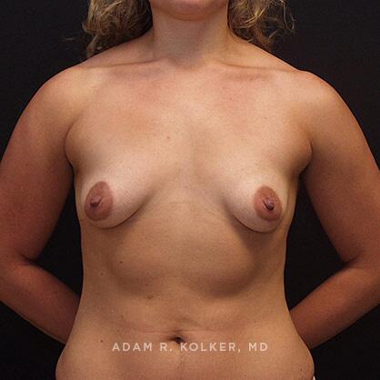 Breast Lift Before Image Patient 17 Front View