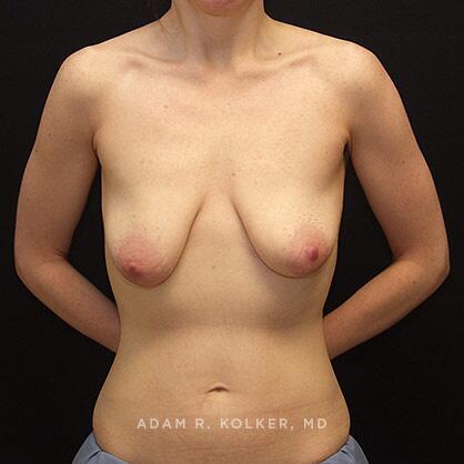 Breast Lift Before Image Patient 18 Front View
