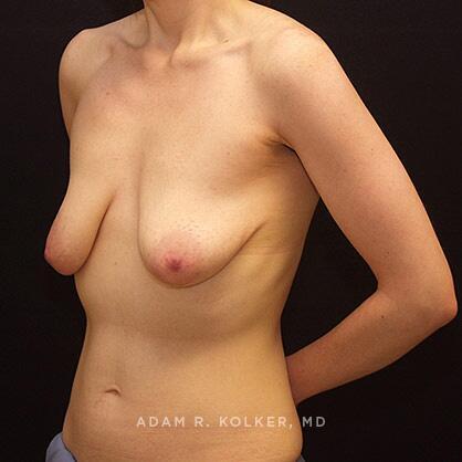 Breast Lift Before Image Patient 18 Oblique View
