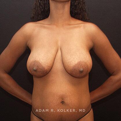 Breast Lift Before Image Patient 19 Front View