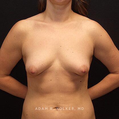 Breast Lift Before Image Patient 20 Front View