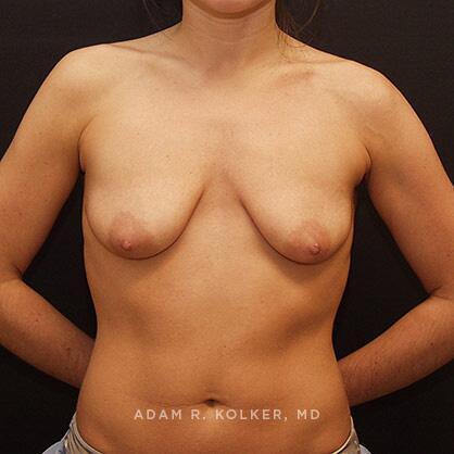 Breast Lift Before Image Patient 23 Front View