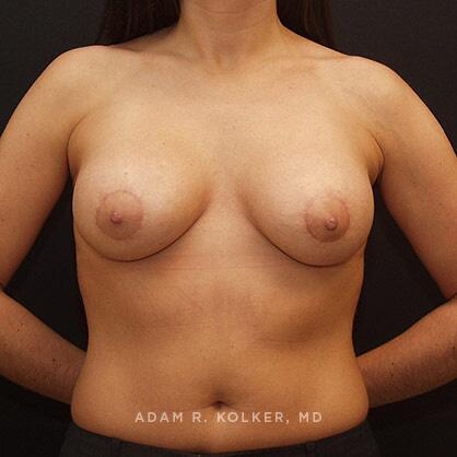 Breast Lift After Image Patient 23 Front View
