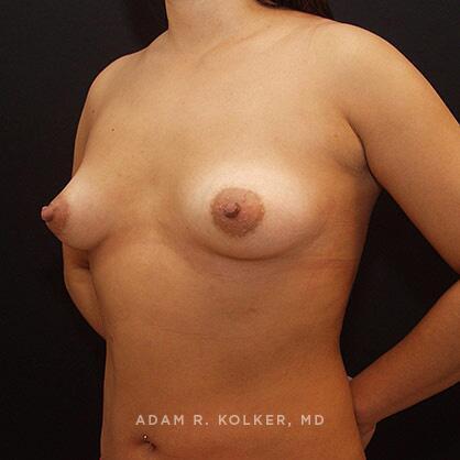 Breast Lift Before Image Patient 24 Oblique View