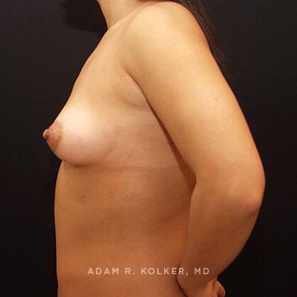 Breast Lift Before Image Patient 24 Side View