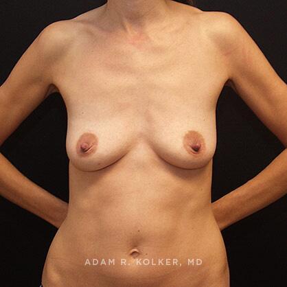 Breast Lift Before Image Patient 25 Front View