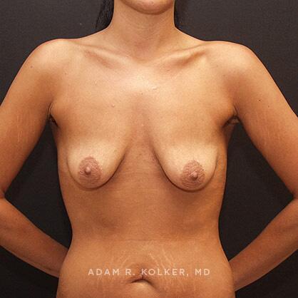 Breast Lift Before Image Patient 28 Front View