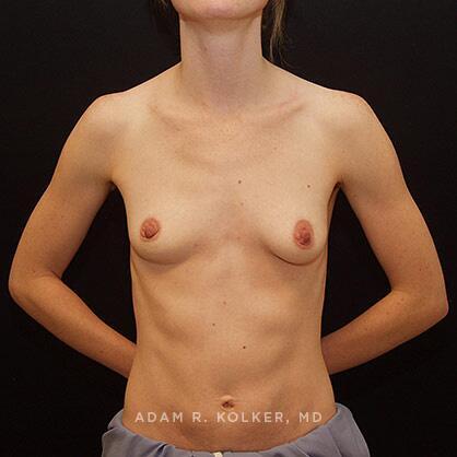 Breast Lift Before Image Patient 29 Front View