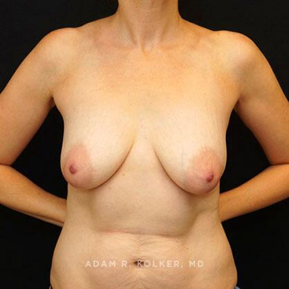 Breast Lift Before Image Patient 30 Front View