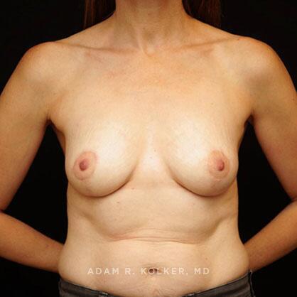 Breast Lift After Image Patient 30 Front View
