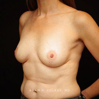 Breast Lift After Image Patient 30 Oblique View
