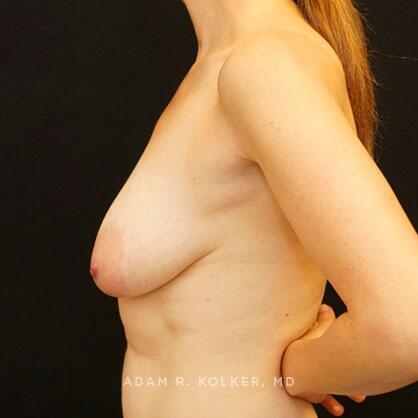 Breast Lift Before Image Patient 30 Side View