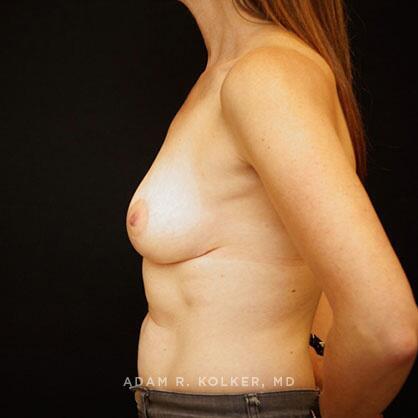 Breast Lift After Image Patient 30 Side View