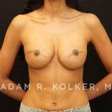 Breast Reconstruction After Image Patient 09 Front View