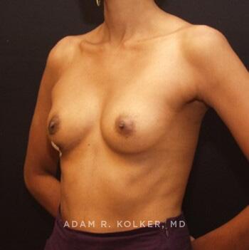 Breast Reconstruction Before Image Patient 09 Oblique View
