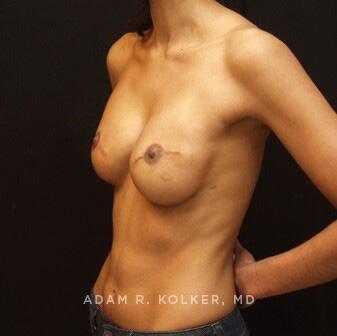 Breast Reconstruction After Image Patient 09 Oblique View