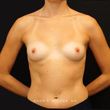 Breast Reconstruction Before Image Patient 13 Front View