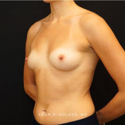 Breast Reconstruction Before Image Patient 13 Oblique View