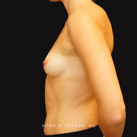 Breast Reconstruction Before Image Patient 13 Side View