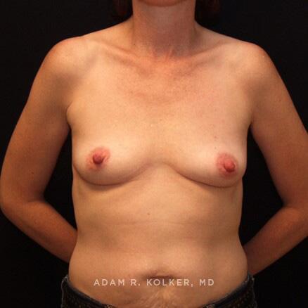 Breast Reconstruction Before Image Patient 14 Front View