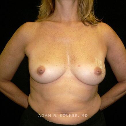 Breast Reconstruction Before Image Patient 15 Front View
