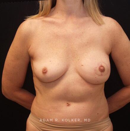 Breast Reconstruction After Image Patient 15 Front View