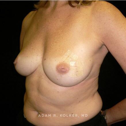 Breast Reconstruction Before Image Patient 15 Oblique View