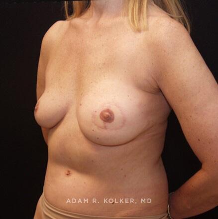 Breast Reconstruction After Image Patient 15 Oblique View
