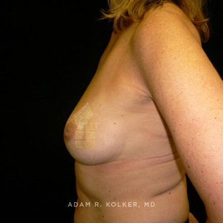 Breast Reconstruction Before Image Patient 15 Side View