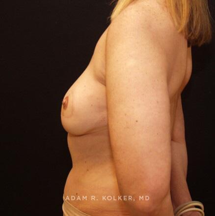 Breast Reconstruction After Image Patient 15 Side View