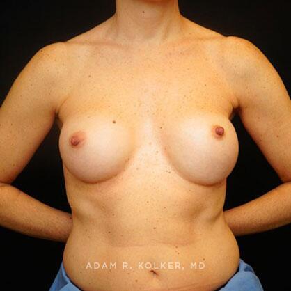 Breast Reconstruction Before Image Patient 16 Front View