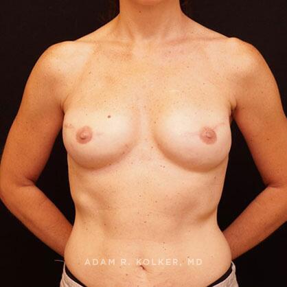 Breast Reconstruction After Image Patient 16 Front View