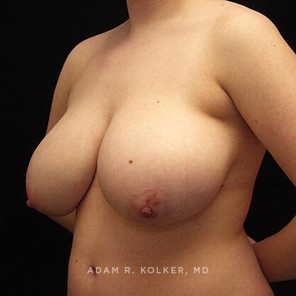 Breast Reduction Before Image Patient 02 Oblique View