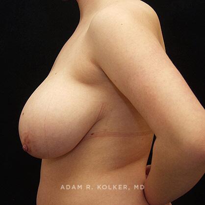 Breast Reduction Before Image Patient 02 Side View