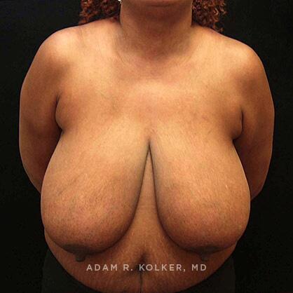 Breast Reduction Before Image Patient 03 Front View