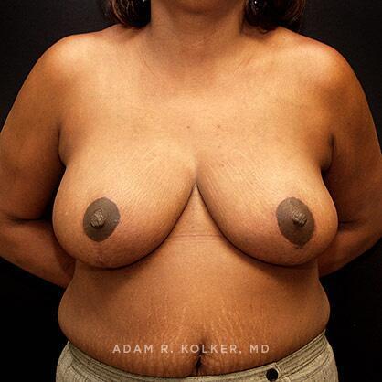 Breast Reduction After Image Patient 03 Front View
