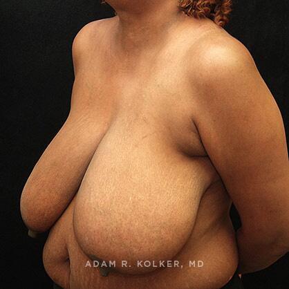 Breast Reduction Before Image Patient 03 Oblique View