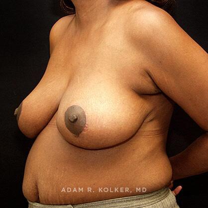 Breast Reduction After Image Patient 03 Oblique View