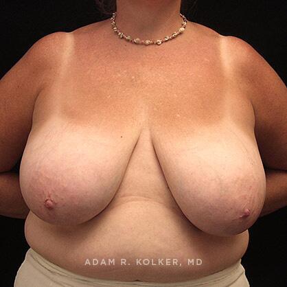 Breast Reduction Before Image Patient 04 Front View