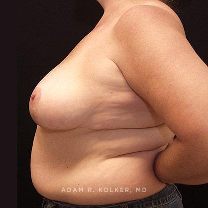 Breast Reduction After Image Patient 04 Side View