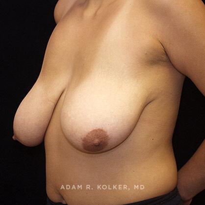 Breast Reduction Before Image Patient 06 Oblique View