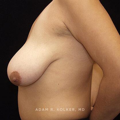 Breast Reduction Before Image Patient 06 Side View