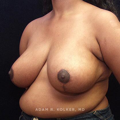 Breast Reduction After Image Patient 07 Oblique View