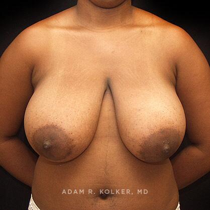 Breast Reduction Before Image Patient 08 Front View