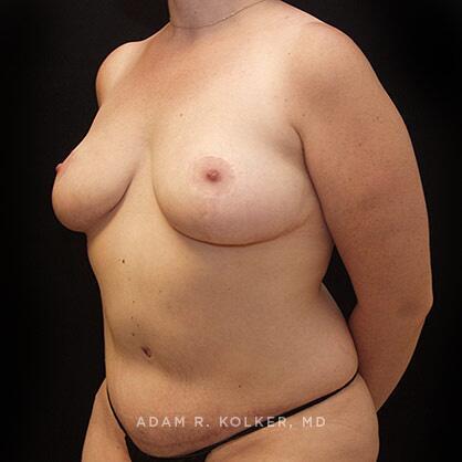 Breast Reduction After Image Patient 10 Oblique View