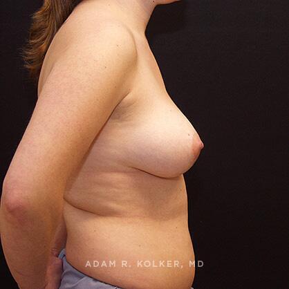 Breast Reduction Before Image Patient 12 Side View