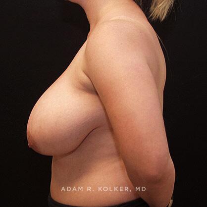 Breast Reduction Before Image Patient 13 Side View