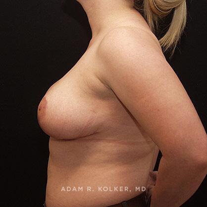 Breast Reduction After Image Patient 13 Side View