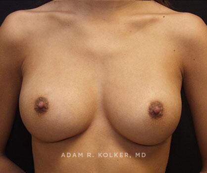 Inverted Nipple Correction After Image Patient 01 Front View